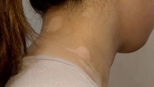 10 физических уродств от болезней или состоянийБелые пятна на коже / изменение цвета кожи (White spots on skin/discoloration of skin)